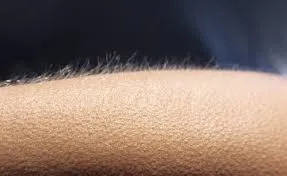Gåshud